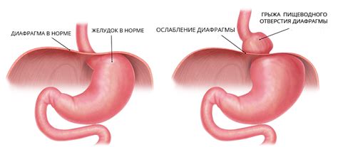 Грыжа пищевода - physiotherapy.ru