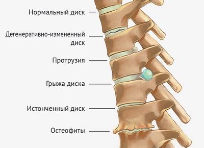 Дорсопатия: что такое дорсопатия поясничного и пояснично-крестцового ...