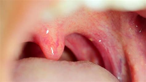 mengetahui gejala penyakit amandel  pengobatannya digiteknesia