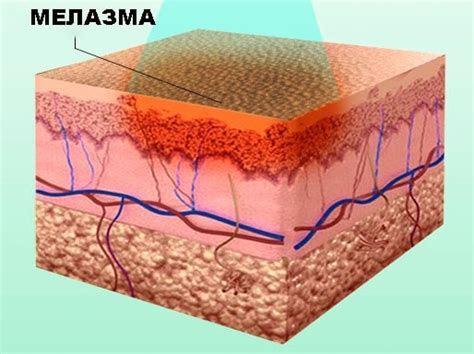 Мелазма: лікування мелазми лазером у МЦ Лазерсвіт Одеса