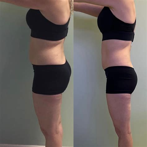 Before & After Gallery – Slim Me