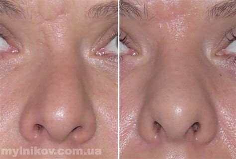 Отечность в носу чем лечить: Эффективные способы снятия отека слизистой ...