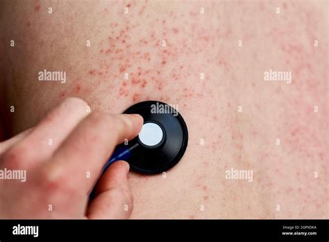 skin rash  high resolution stock photography  images alamy