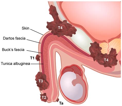 Penile Cancer Photographs Of Different Peniscopic Patterns Of