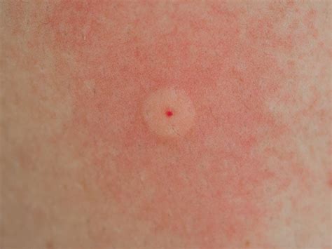 Alergia A Picada De Abelha