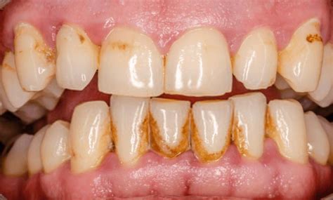 Porque Da Tartaro Nos Dentes - Tártaro nos dentes ou Cáculo dental - o que é, como remover