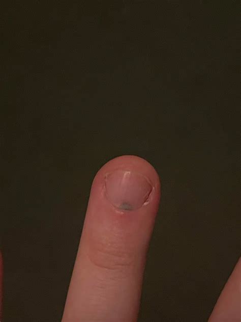 Does this look like a mole under the nail bed? I can’t remember