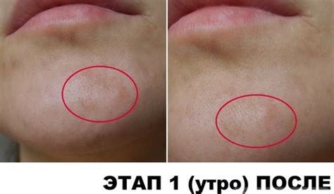 Помогает ли Ихтиоловая мазь от прыщей на лице и как наносить? Отзывы