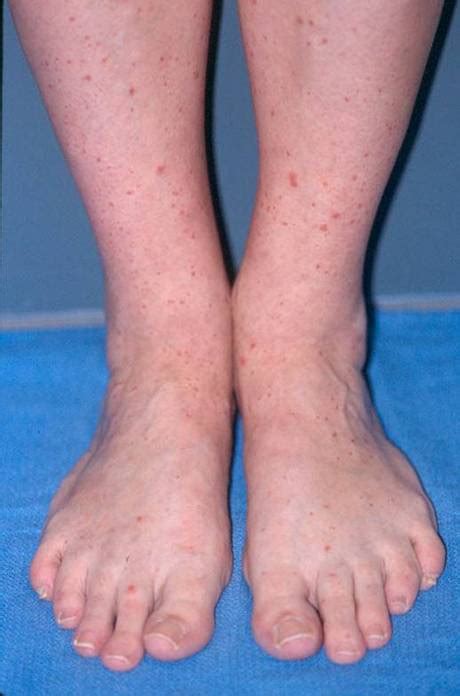 Purpura, Schoenlein-Henoch; Allergic Purpura; Anaphylactoid Purpura ...