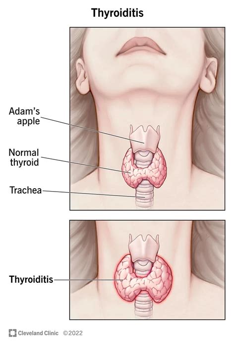 Thyroid: Causes, Symptoms and Treatment - Public Health Notes