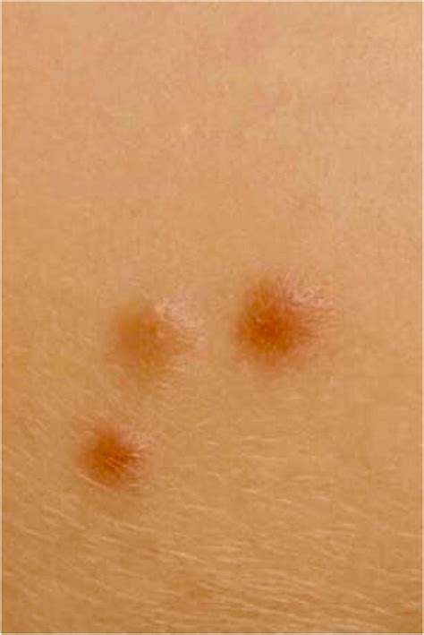 Synchronous occurrence of primary cutaneous B‐cell lymphoma and
