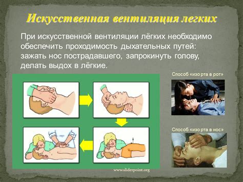 Искусственная вентиляция легких