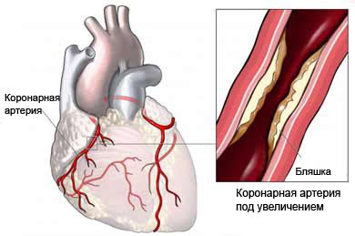 Стенокардия - Описание, диагностика, лечение болезней