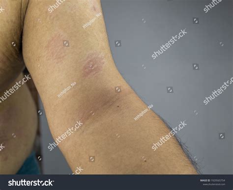 skin disease closeup upper arm area stock photo  shutterstock
