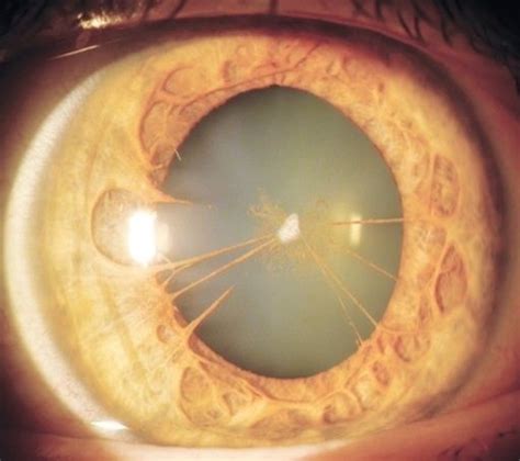 Persistent pupillary membrane