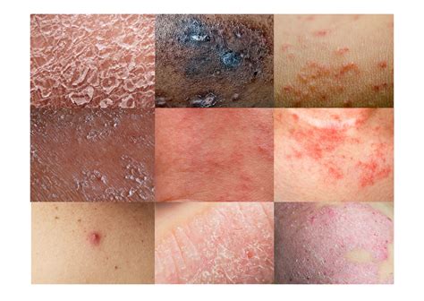 Different Types of Eczema – P2 & You