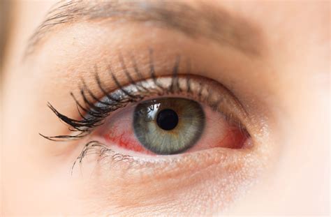 10 Causes & Treatments for Eye Redness | Niagara Falls, ON