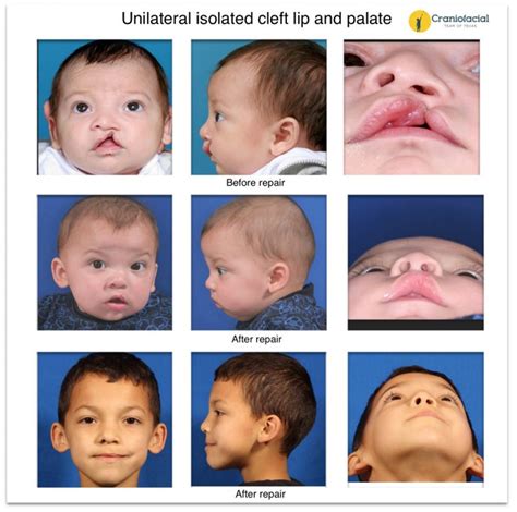 unilateral isolated cleft lip dell childrens craniofacial team  texas
