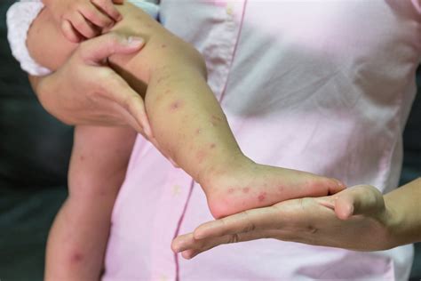 home treatments for hand foot and mouth 1