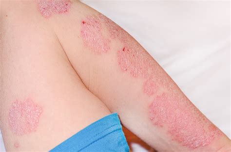 benarkah eritroderma terjadi akibat alergi obat  faktanya