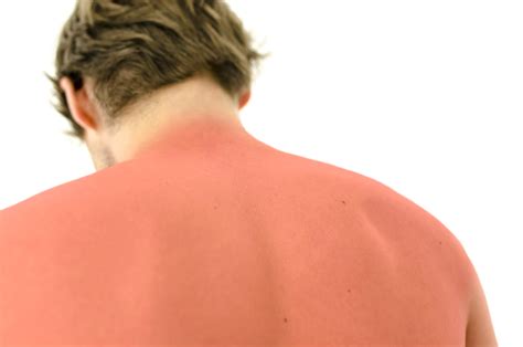 how to know if you have skin cancer from sunburn
