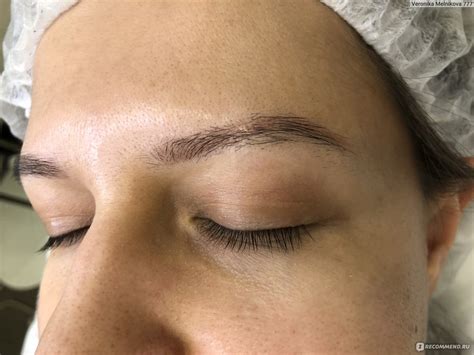 Удаление татуажа бровей пикосекундным лазером PicoSure! - «Лазерное ...