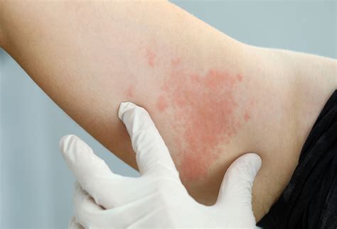 What Is Causing My Rash – And How Do I Treat It? | The Well by Northwell