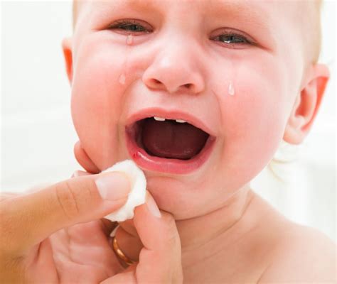 Afte nei bambini: cause e rimedi - Nostrofiglio.it