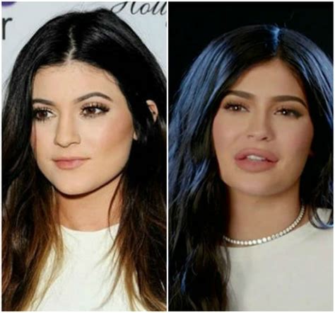 Kylie Jenner's Lips - Before and After Pictures of Her Pout