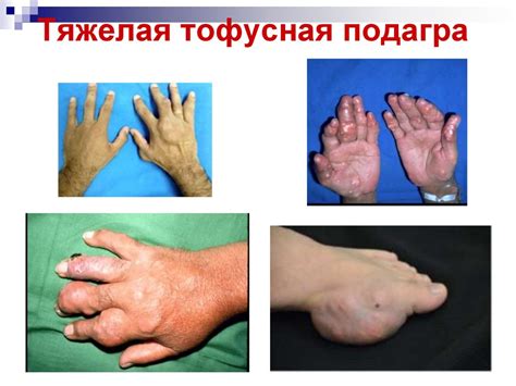 Подагра. Эпидемиология - презентация онлайн