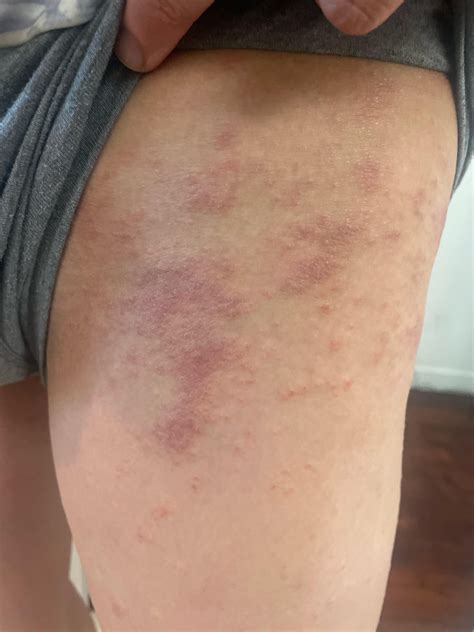 Does this look like an autoimmune rash? : r/Autoimmune