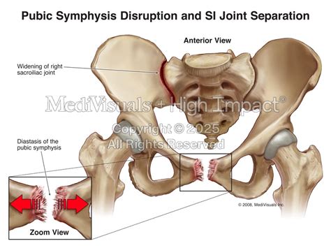 pubic symphysis disruption  joint high impact