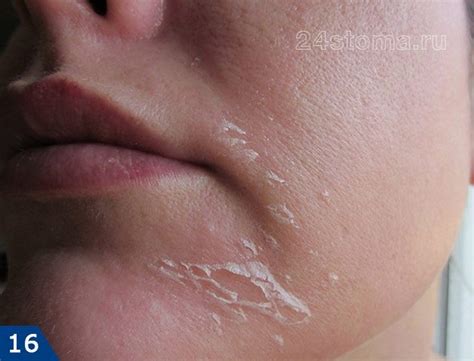 Третиноин крем от прыщей и морщин – отзывы, фото до и после, минусы