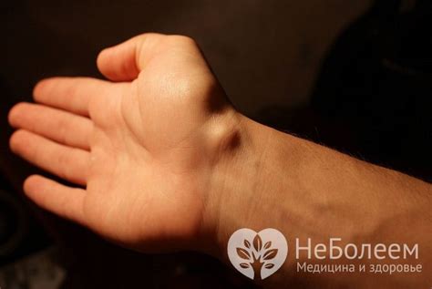 Гигрома кисти – лечение, гигрома лучезапястного сустава кисти