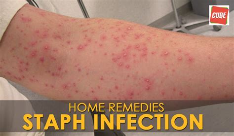 Staph Infection Long Term Effects at Leslie Welch blog