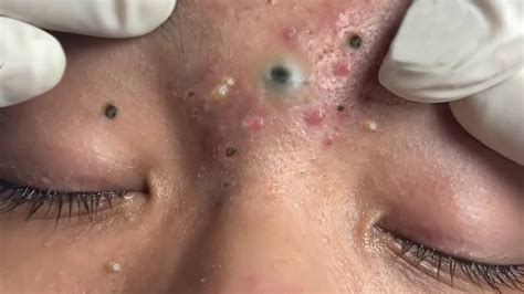 blackheads acne pimples popping  george farrow blog