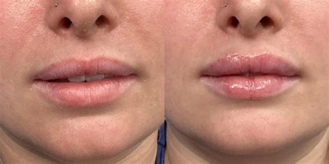 Fillers Before & After Gallery