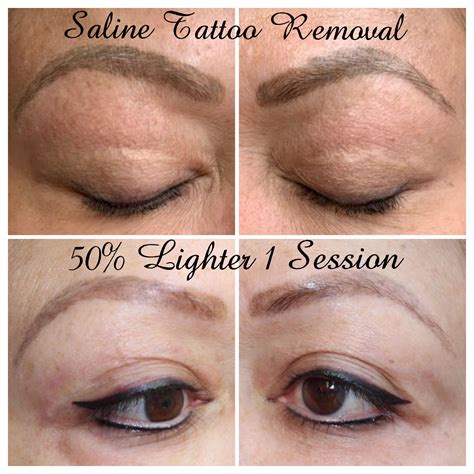 tattoo removal for eyebrows 6
