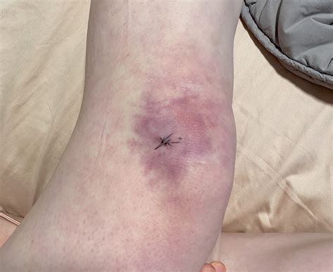 Mysterious rashes with systemic symptoms :( : r/DermatologyQuestions