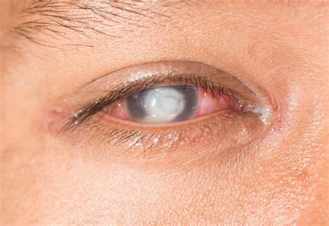 Corneal Ulcer: Causes, Symptoms & Treatment | Eye Concepts