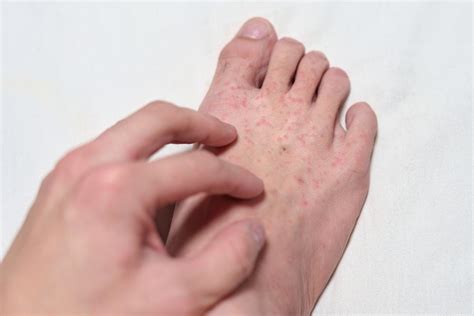 Bolinhas Que Coçam No Pé - Espinhas nos pés que coçam muito: causas e tratamento