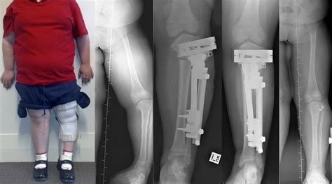 mackie orthopaedics bone deformity correction