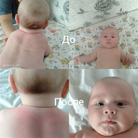 Кривошея у грудничка: признаки, симптомы и лечение