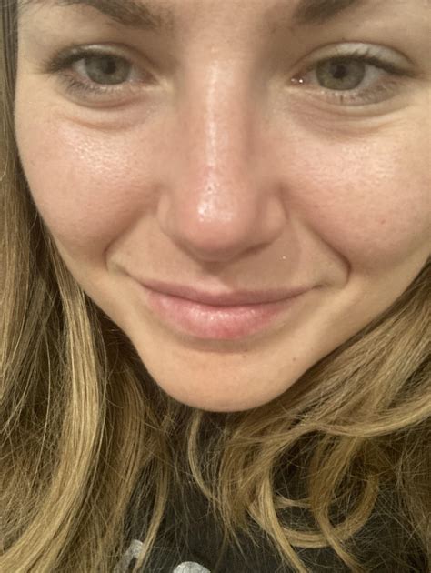 New under eye bags when I smile. 31 years old and literally hate it! I