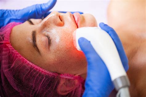 Rosacea Care in Annapolis, MD | Warrior Medical Group