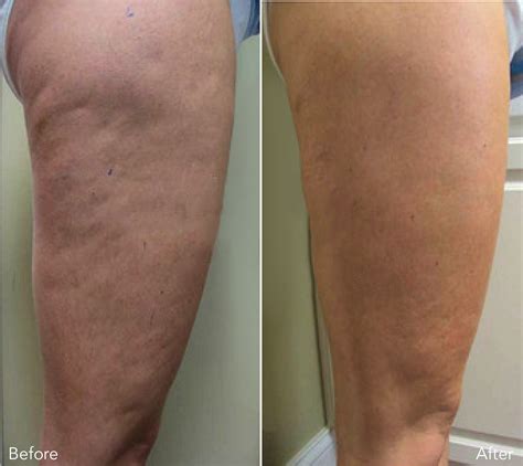 Cellulite Legs Before And After Weight Loss at Miguel Harbison blog