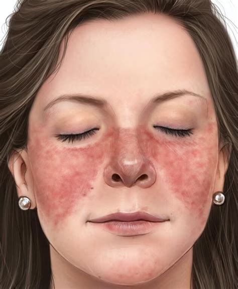 mengenal penyebab  timbulnya penyakit lupus