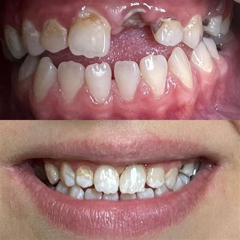 Імплантація | IMPLANT DENTAL * Стоматологія Львів
