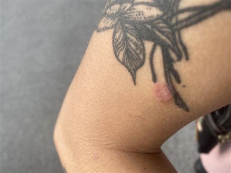 Ringworm??? I work at a cat shelter and had handled two kittens before