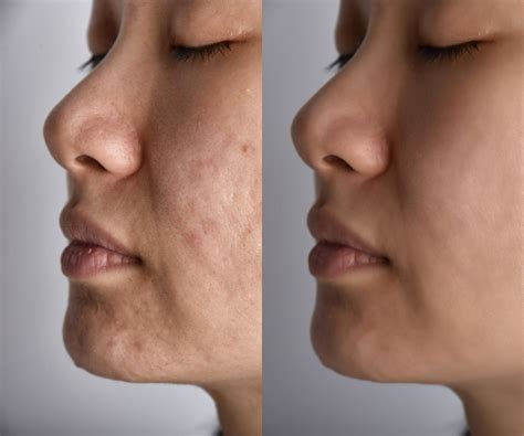 Korean Skin Care for Acne: Get Flawless Skin With K Beauty! - Beauty ...